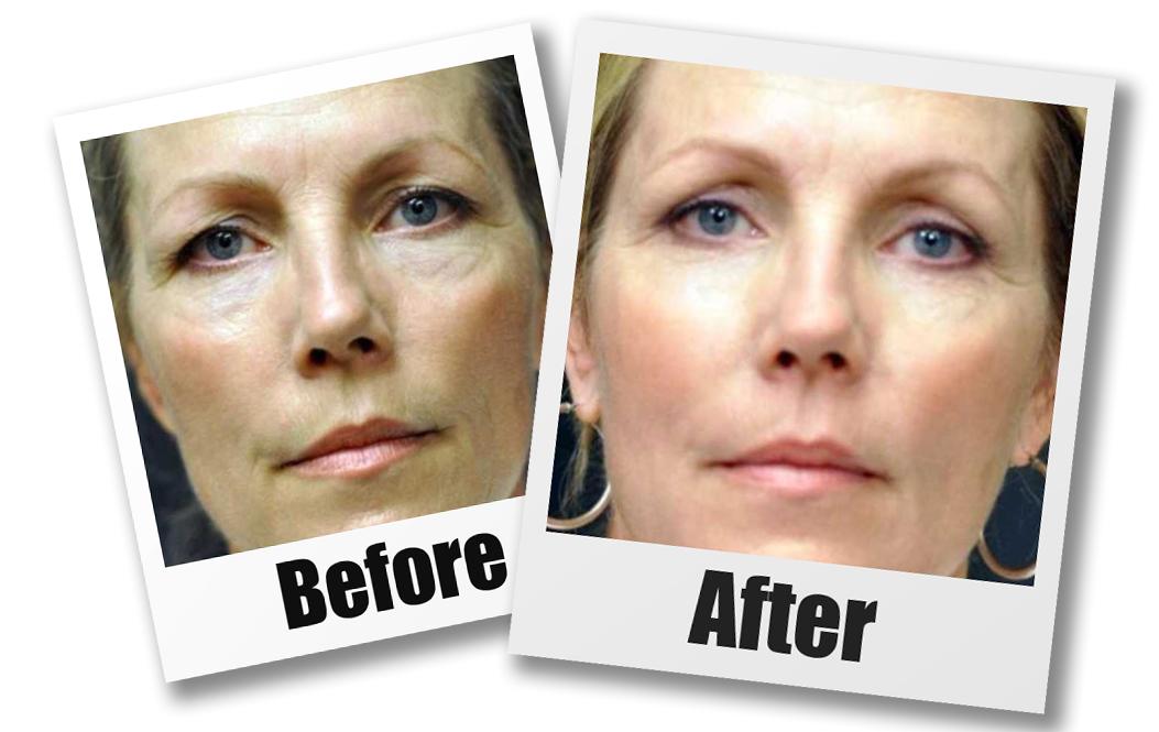 Seattle Eyelid Surgery Cost & Pricing Seattle Plastic Surgery