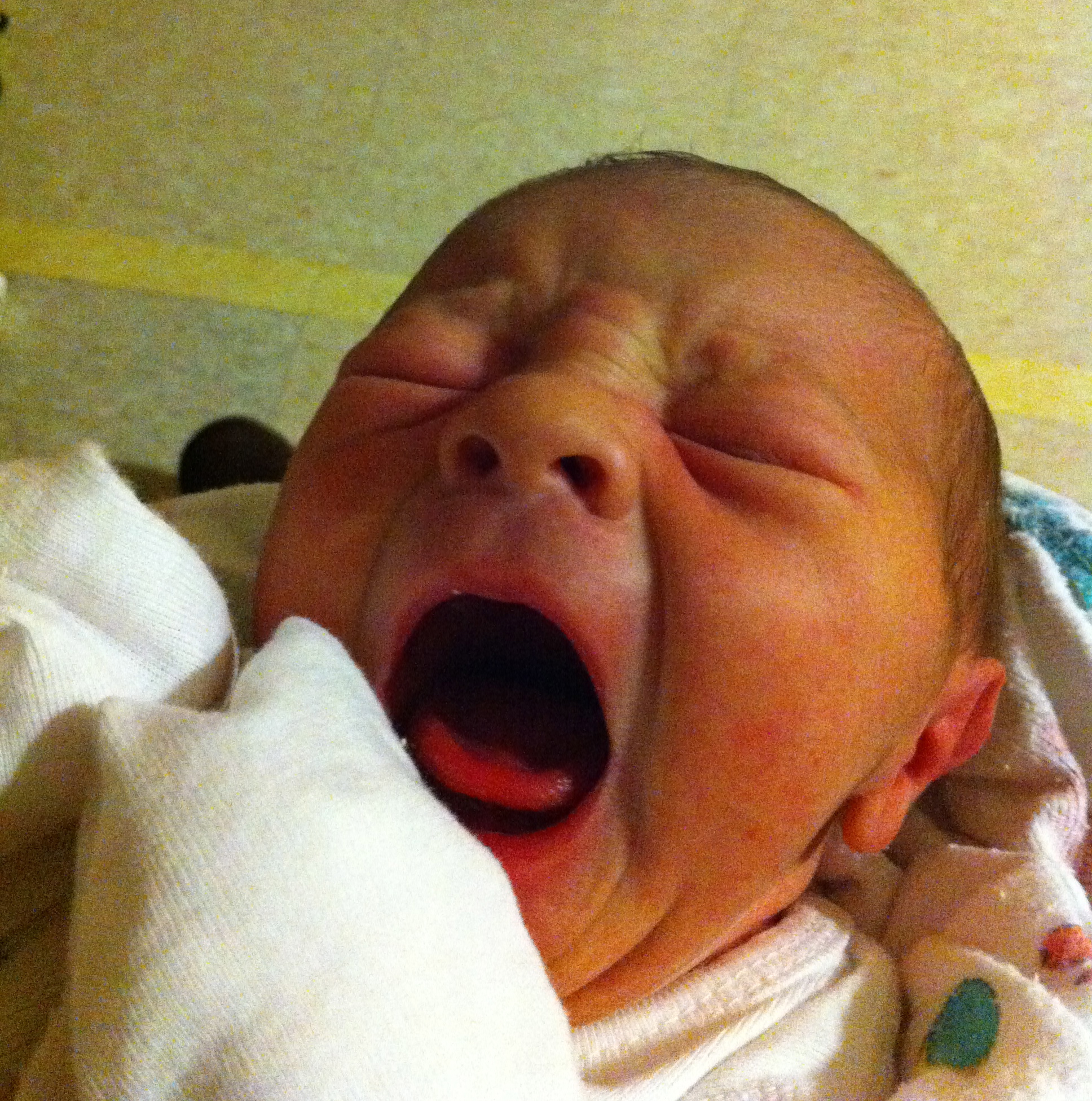 Tongue Tie More than “Just” a Breastfeeding Problem The Second 9 Months