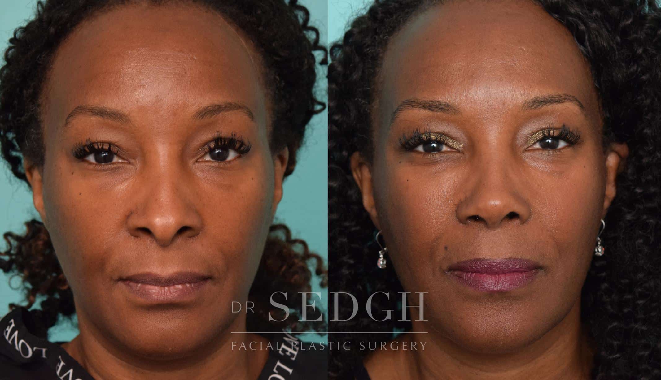 Black Rhinoplasty Before And After