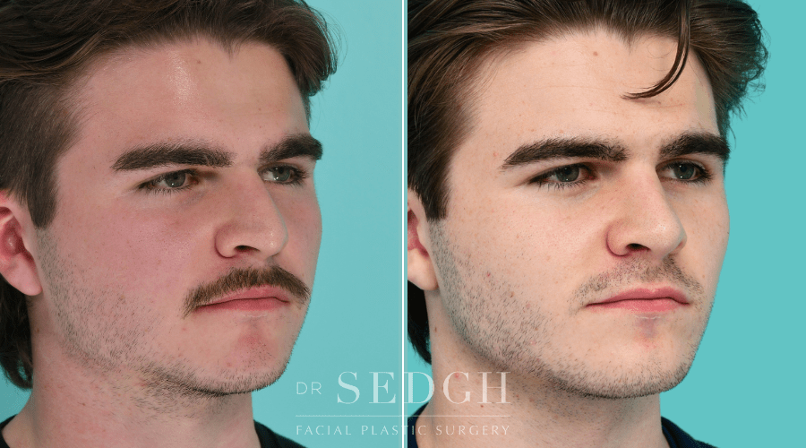 His Plastic Surgery
