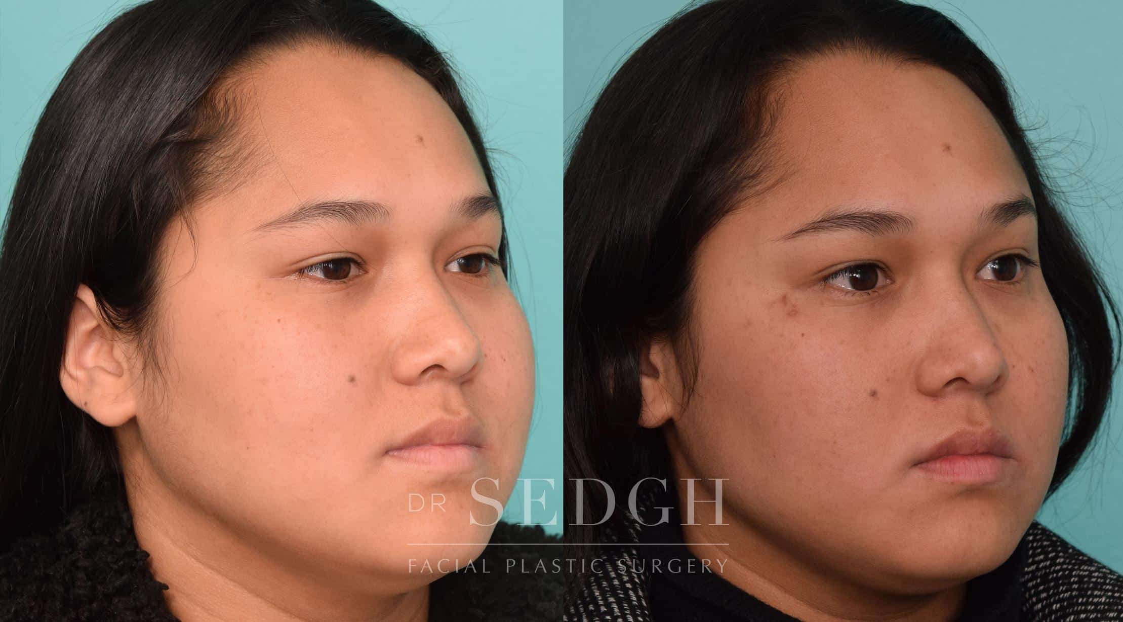 Buccal Fat Reduction Before and After Photos Dr. Sedgh