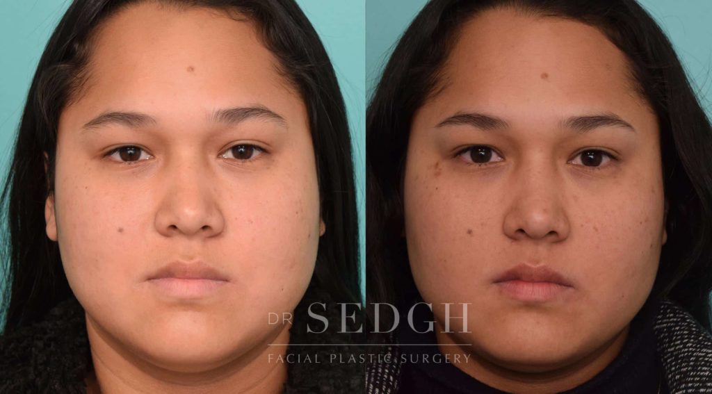 Los Angeles Buccal Fat Removal West Hollywood Cheek Reduction Surgery