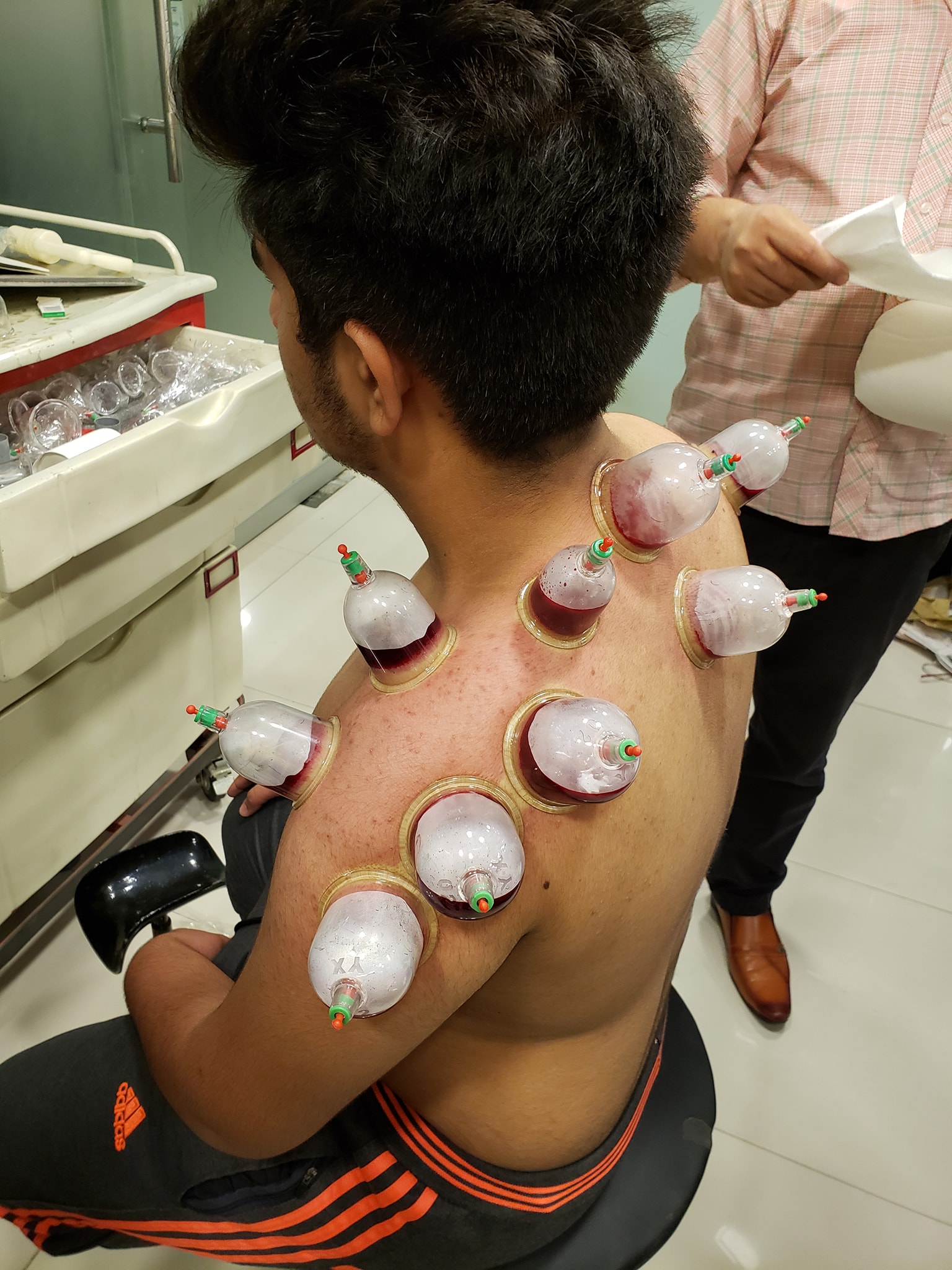 Chinese Cupping Therapy (Hijama) See Do Make