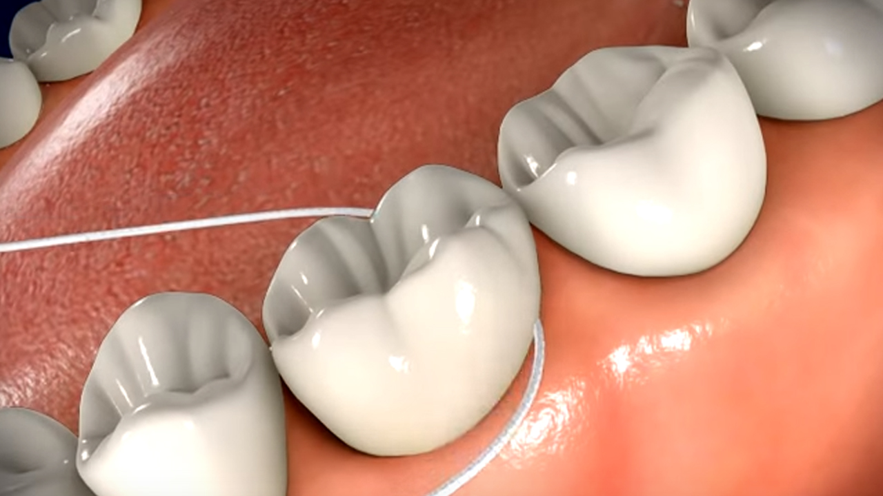 How To Remove Dental Floss Stuck Between Teeth TeethWalls