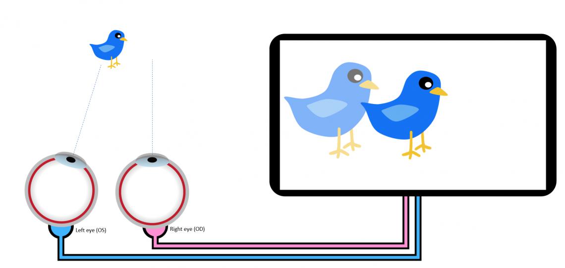 What is Anomalous Retinal Correspondence?