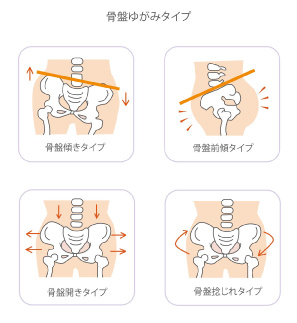 骨盤のゆがみ大丈夫！？骨盤の歪みをチェックする5つの方法 | Bauhütte® 骨盤が歪む原因と症状は？正しい改善方法を解説！ | 小林整骨院コラム
