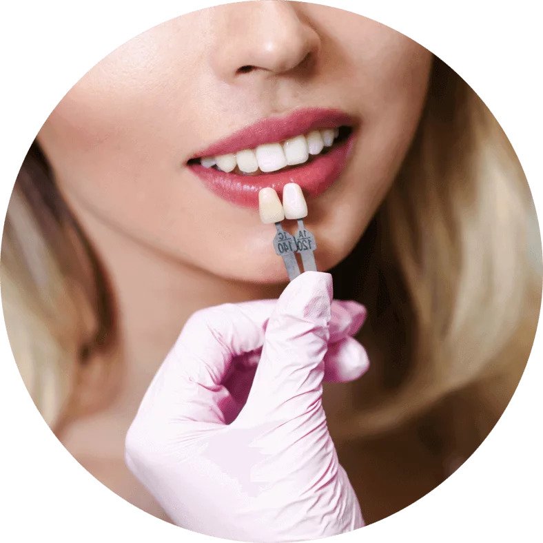 Is It Normal For Veneers To Fall Off?