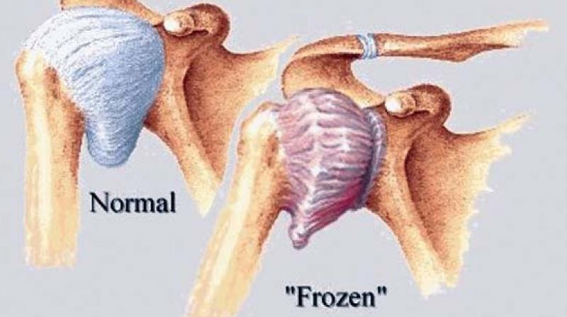 WHAT IS 'FROZEN SHOULDER'? Sports Medicine Clinic SEMI