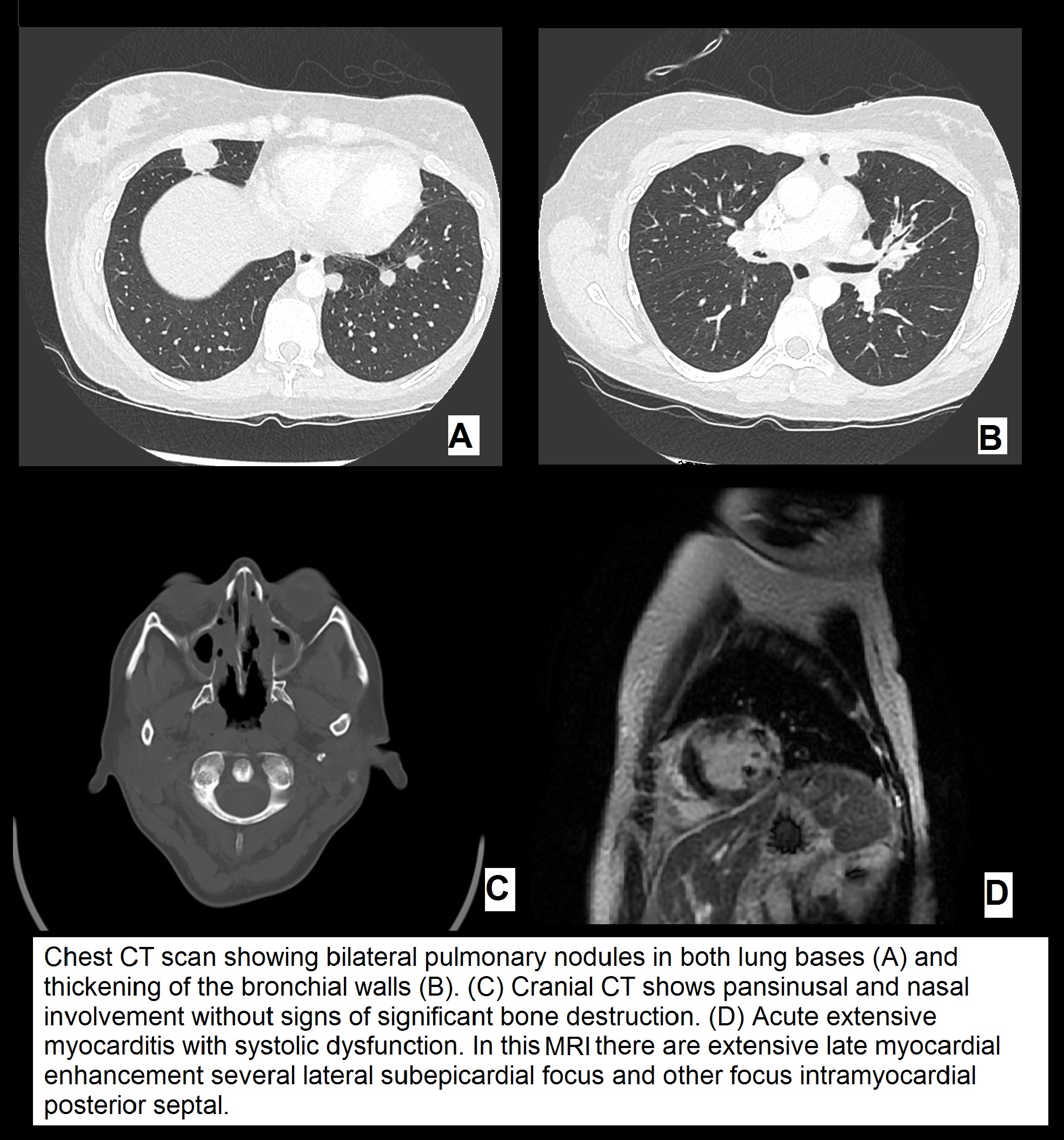 Kaart Nederland Wegener's Disease Wegener’s granulomatosis, a diagnosis that must not be in