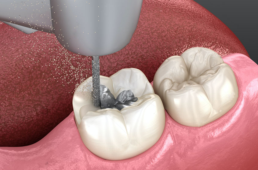 AMALGAM DOLGU NASIL ÇIKARILMALI