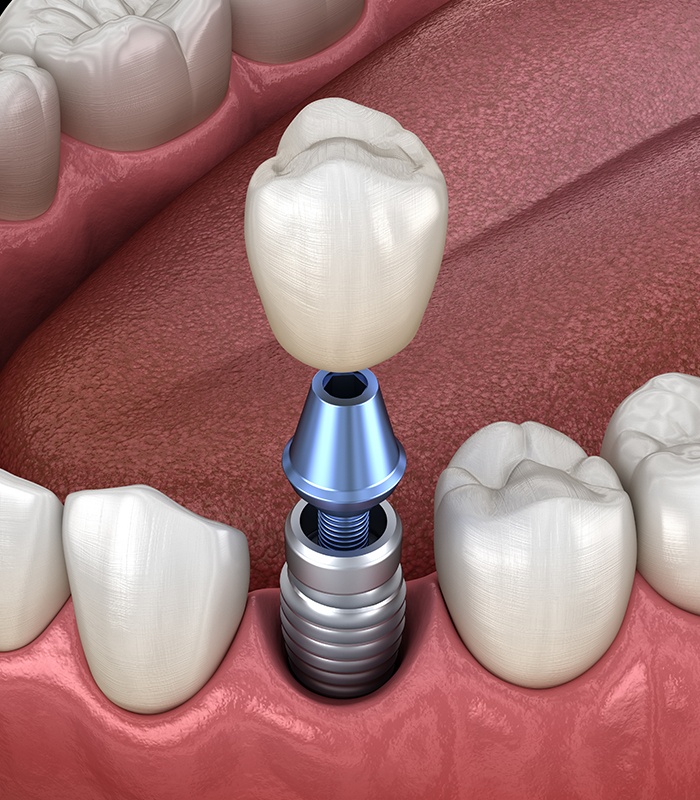 Missing Teeth Jonesboro, AR Dental Implants Dentures