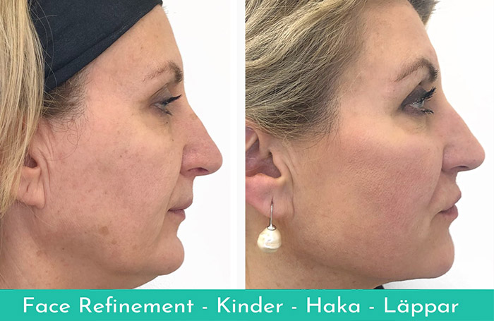 Kindkonturering Skulptering med Filler för Kinder & Kindben ShapeBy®