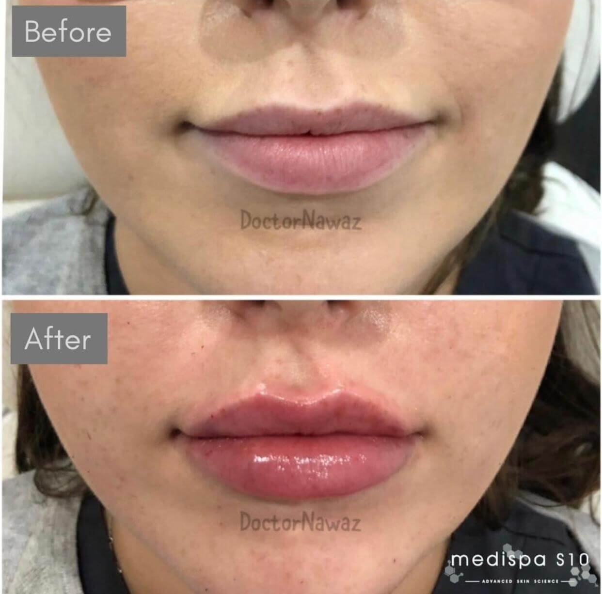 Dermal Fillers Lip Filler and Tear Trough Treatments Medispa S10