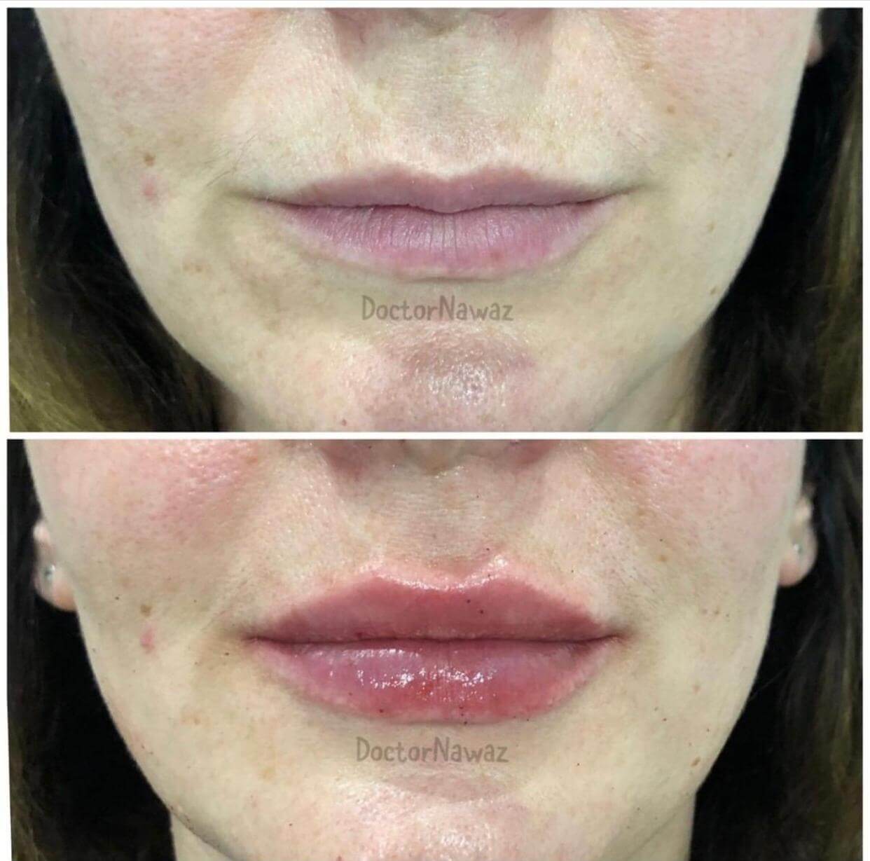Dermal Fillers Lip Filler and Tear Trough Treatments Medispa S10