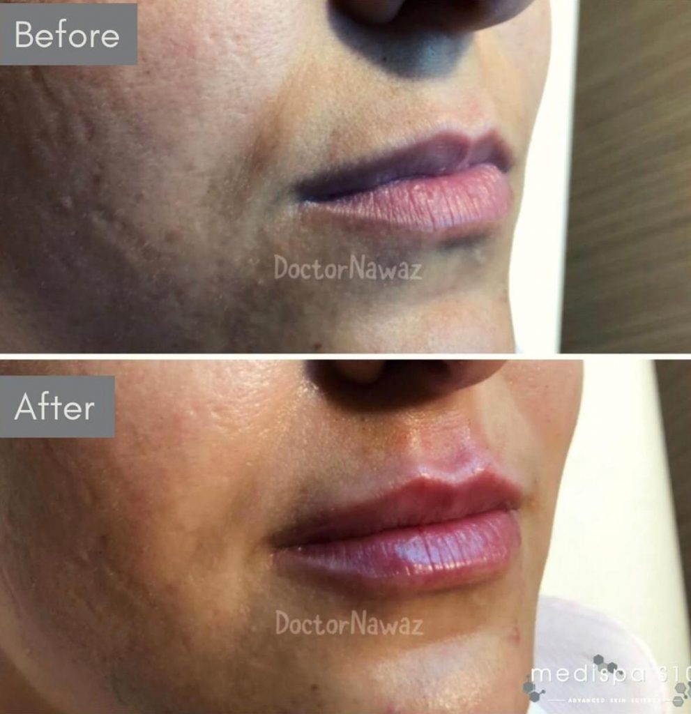 Dermal Fillers Lip Filler and Tear Trough Treatments Medispa S10