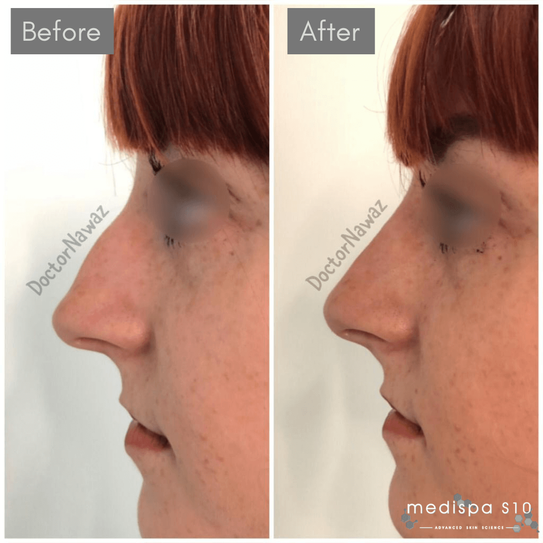 Rhinoplasty The Lunch Time NonSurgical Nose Job Medispa S10
