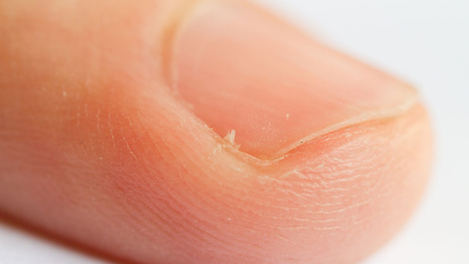 Hangnail Remedies AtHome Remedies SHEfinds