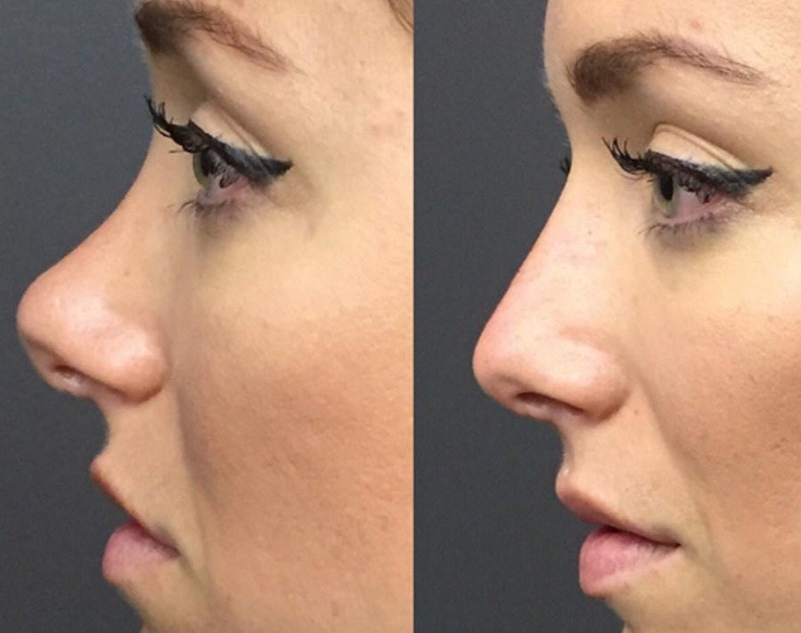 Plastic surgeon says he can now give nose jobs without surgery SheKnows