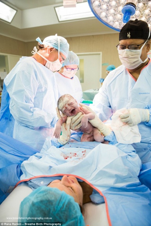 Badass mom delivers her own baby during Csection in incredible photos