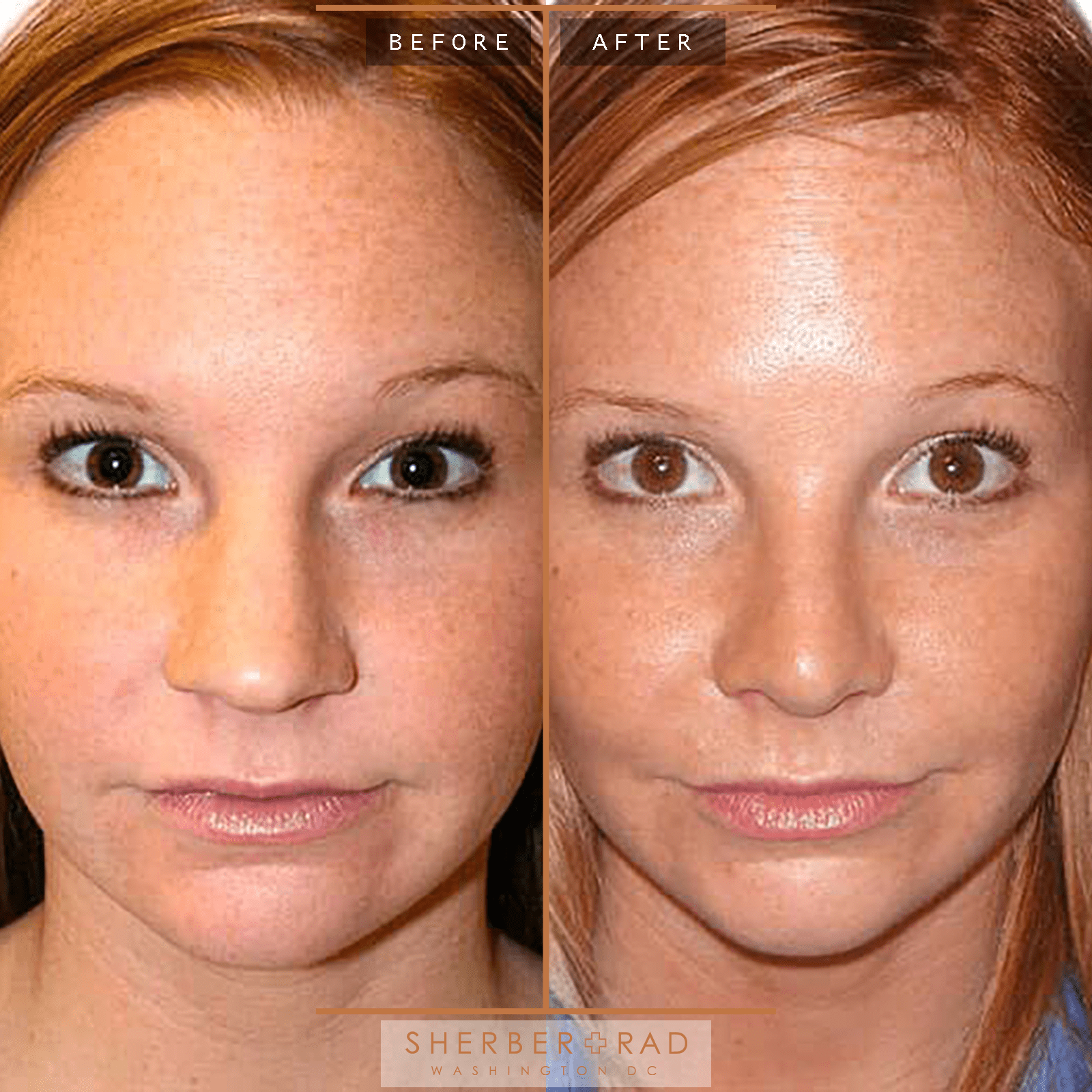 Ethnic Rhinoplasty in Washington DC Sherber + Rad(04)