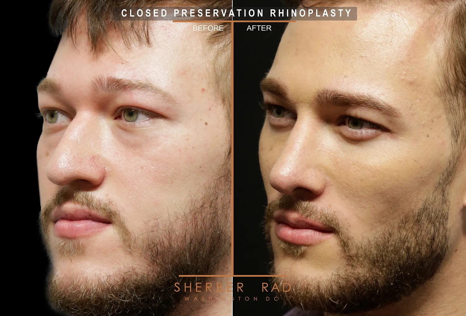 Orbital Implants in Washington DC Sherber + Rad
