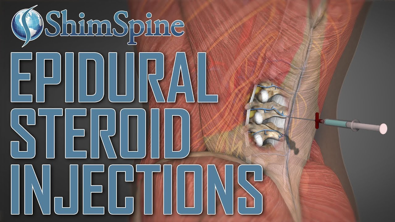 Epidural Steroid Injections ; Do They Work? ShimSpine