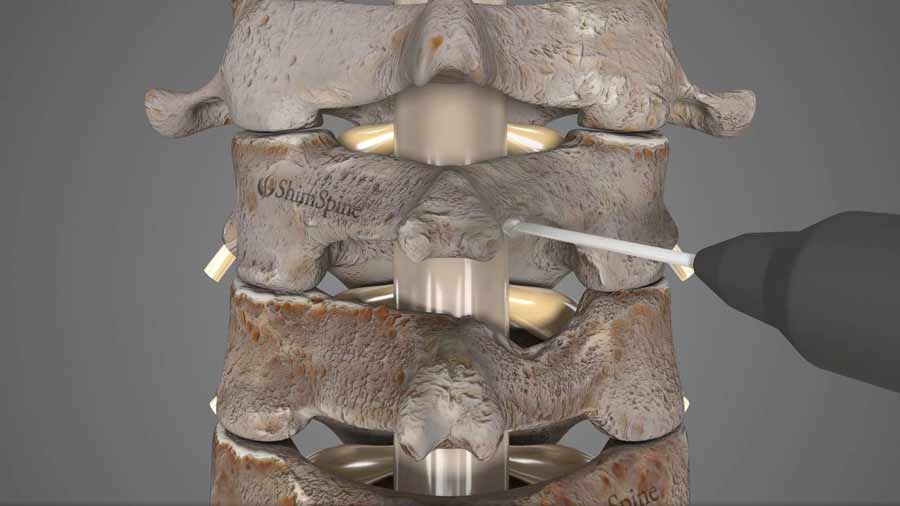 Posterior Cervical Foraminotomy ShimSpine