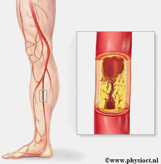 Differentiaal Diagnose - Shin Splint