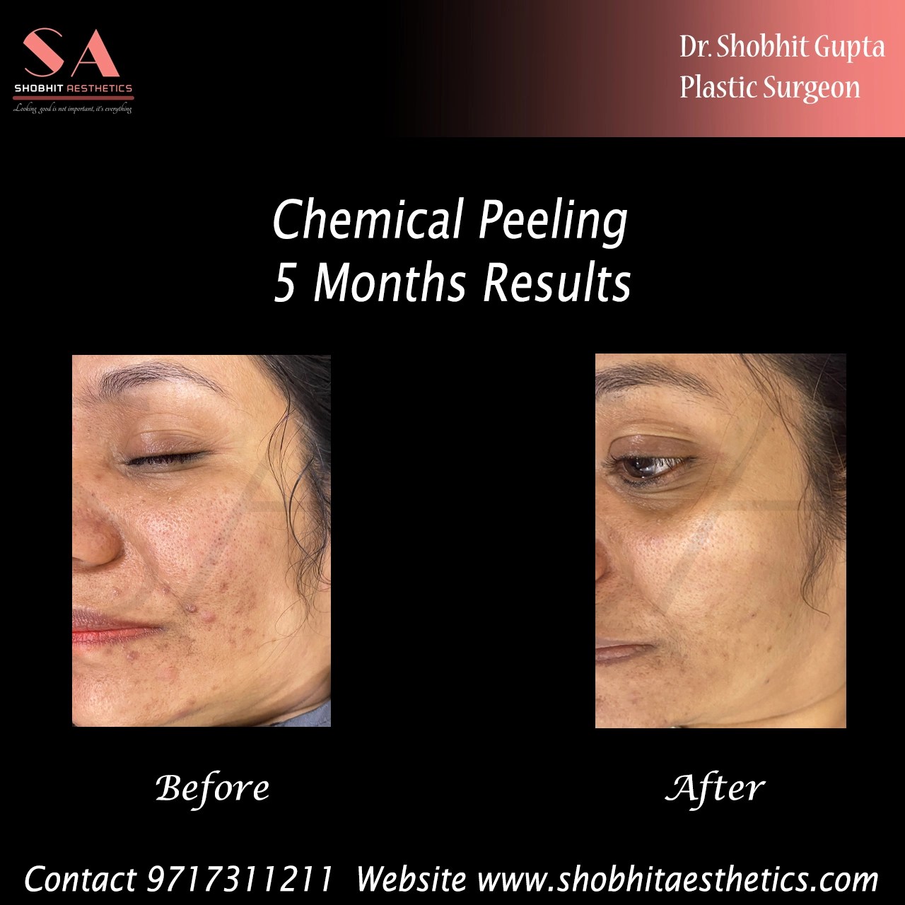 Scar Removal Surgery Cost in Delhi Scar Revision Treatment