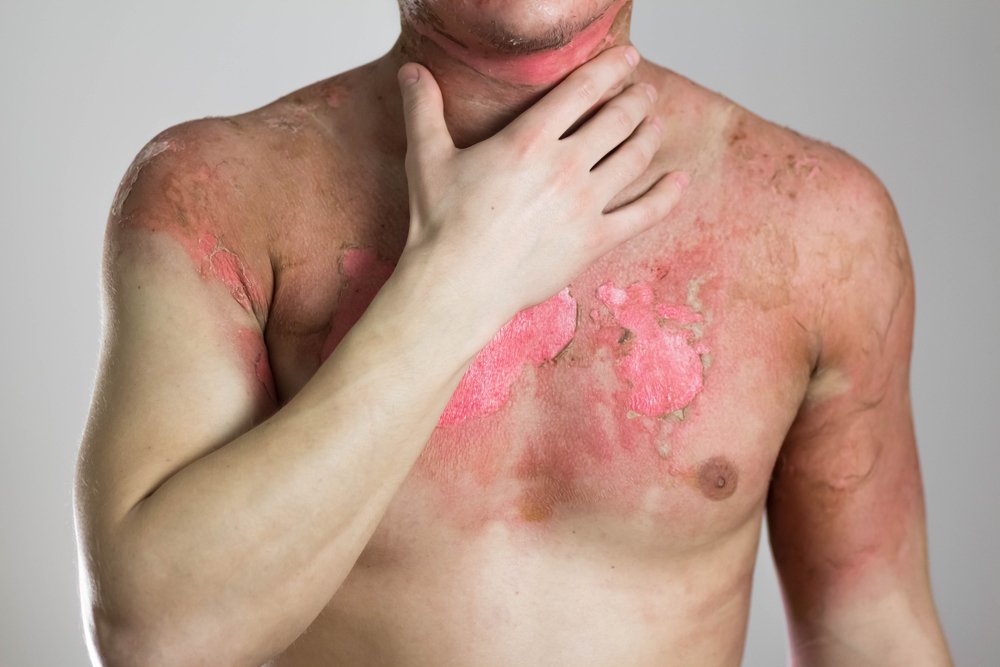How much compensation do you get for a burn injury?