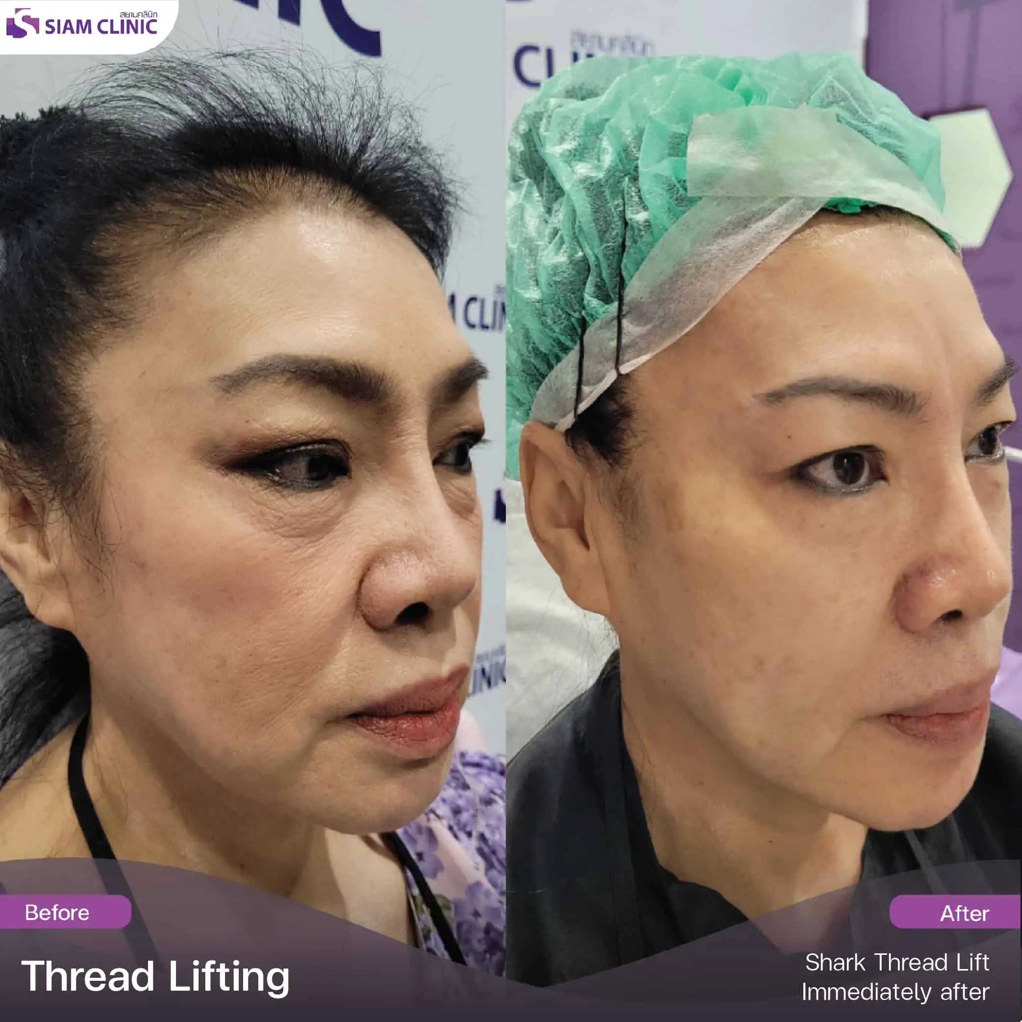 Thread Lifting Review Siam Clinic Aesthetic & Wellness Clinic in Phuket