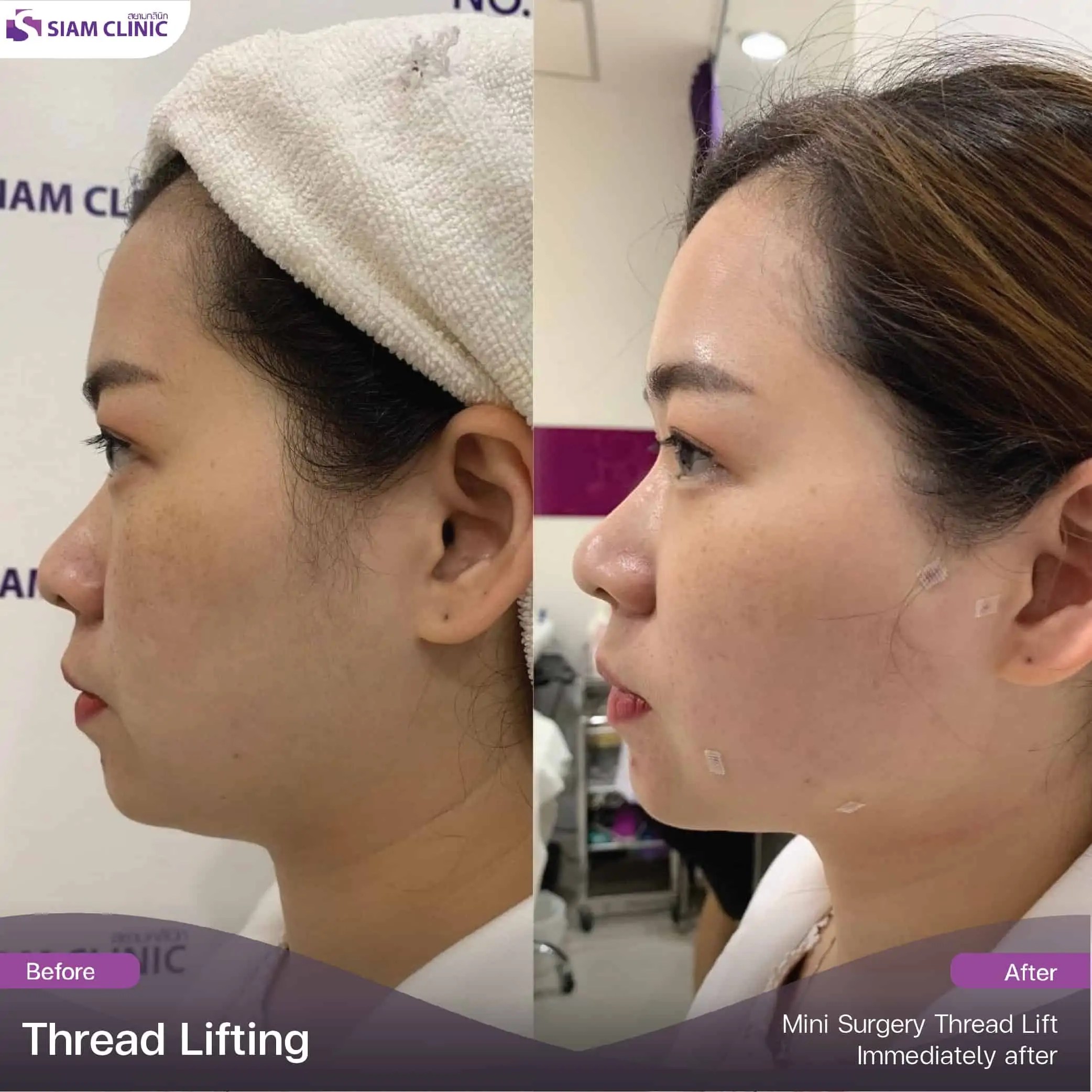 Thread Lifting Review Siam Clinic Aesthetic & Wellness Clinic in Phuket