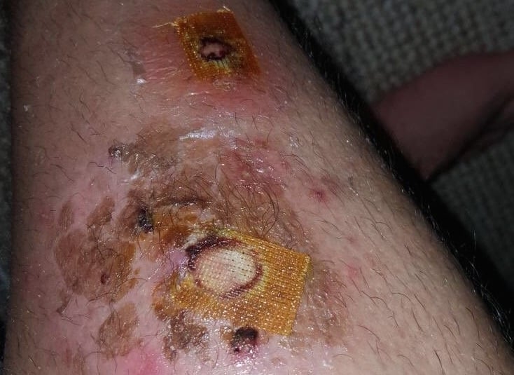 Horrific Photo Shows Man’s Major Injury From False Widow