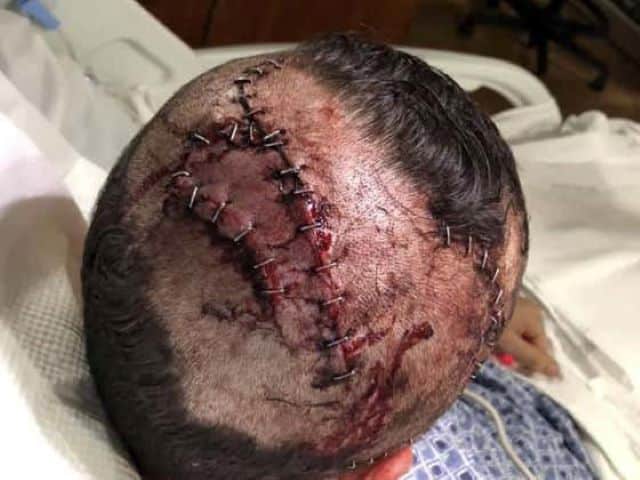 Florida Man Attacked By Alligator While Going For A Swim Shows Off