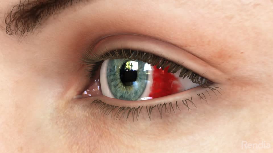 Eye Bleeding What You Need to Know SightMD