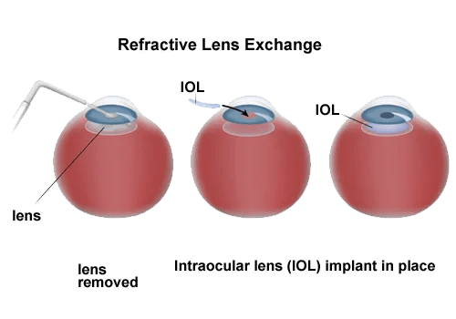 Refractive Lens Exchange Surgery - SightMD