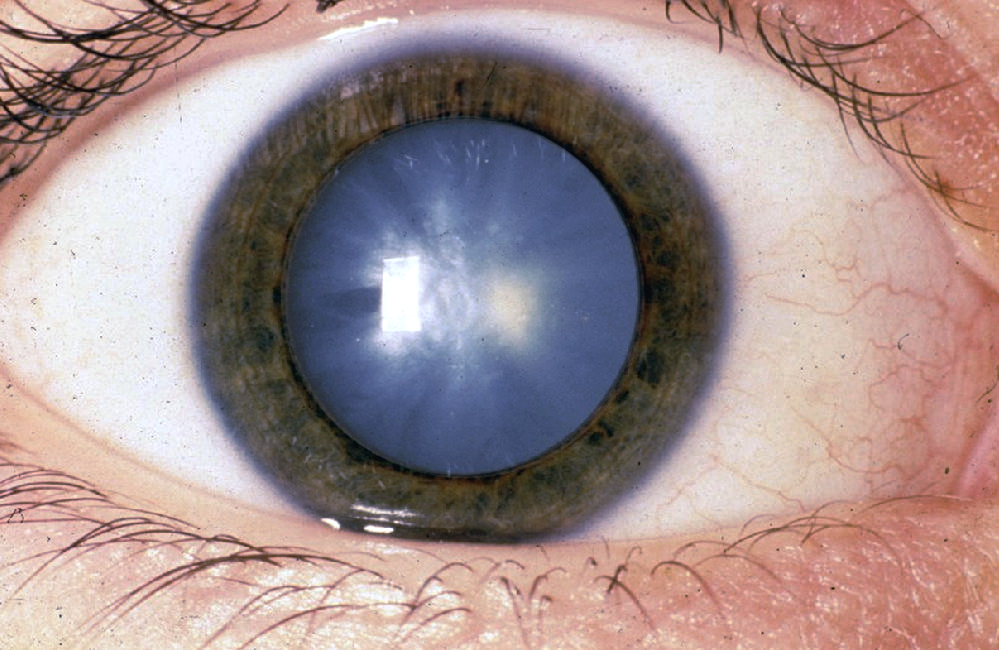 cataract Simply Optometry