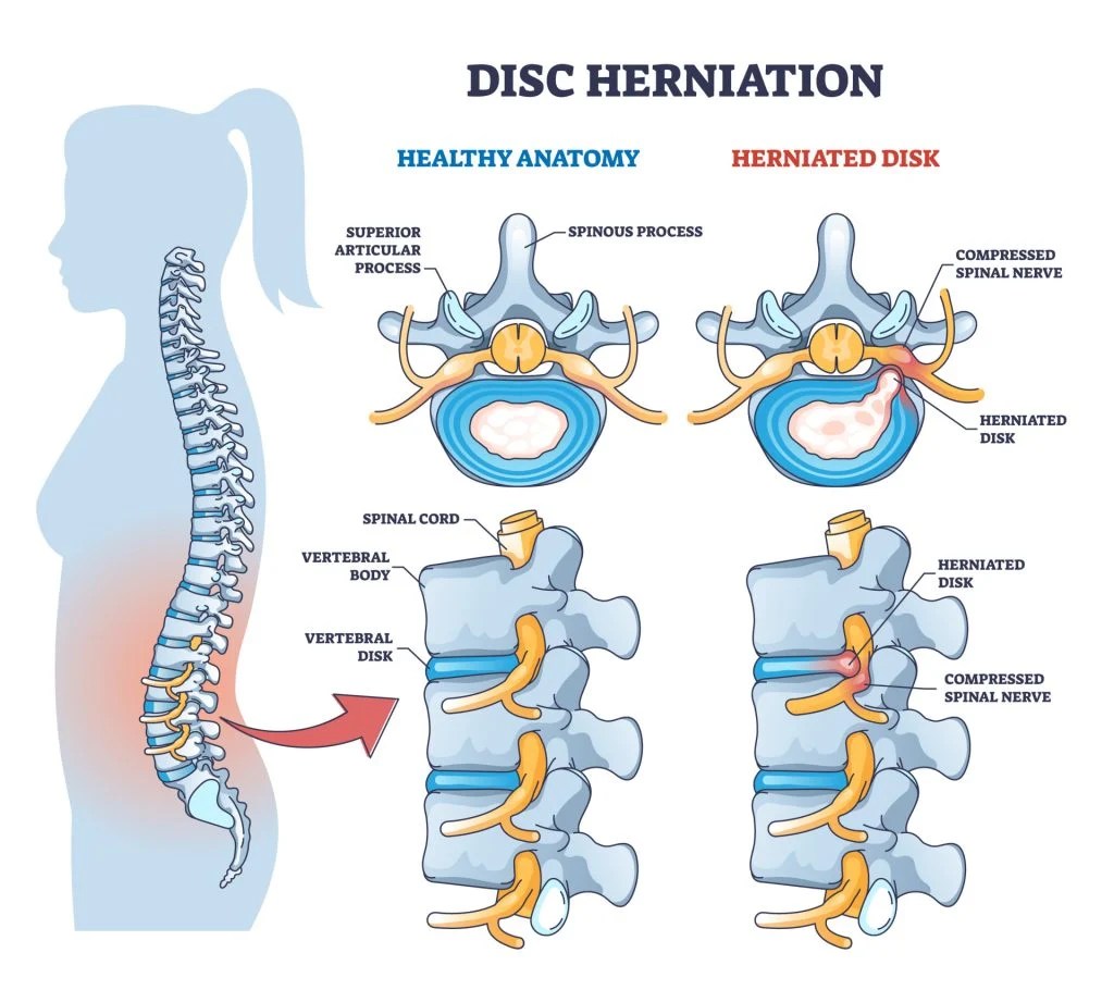 Spinal Nerves What They Are and What They Do