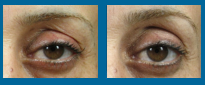 Syneron eMatrix Laser Treatments Before & After Tampa