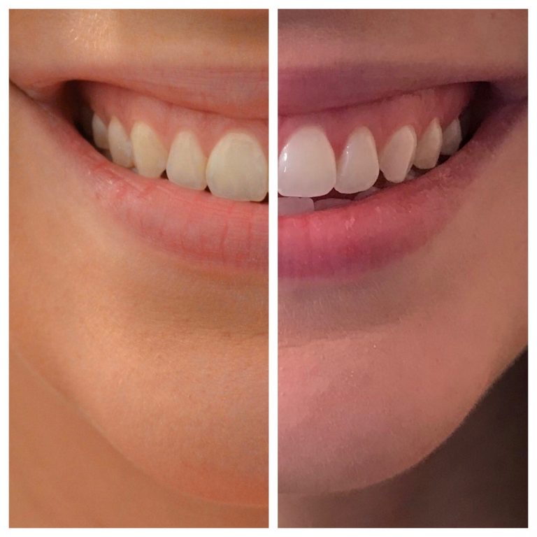 How I Professionally Whitened My Teeth at Home + GIVEAWAY! Sincerely, K