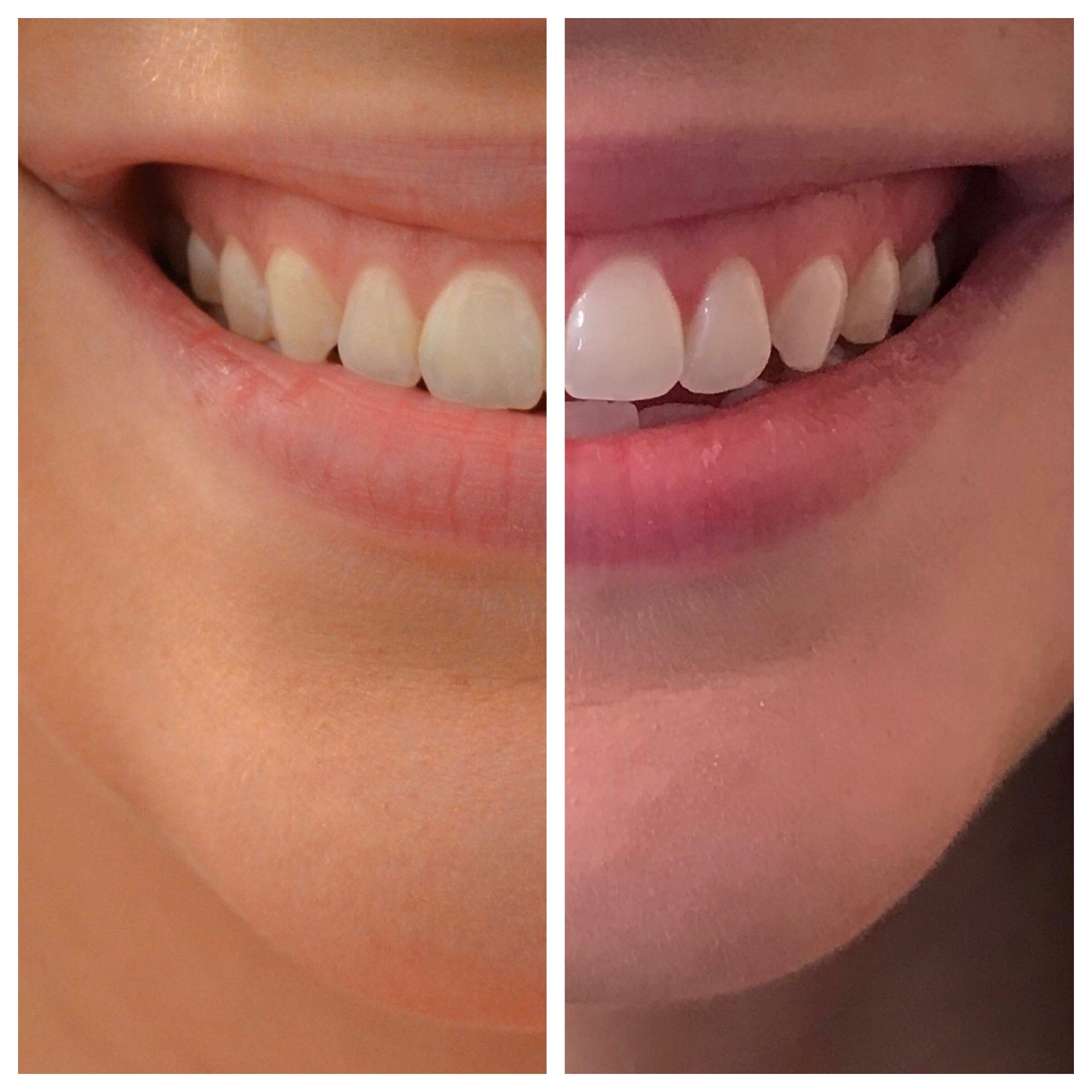 How I Professionally Whitened My Teeth at Home + GIVEAWAY! Sincerely, K