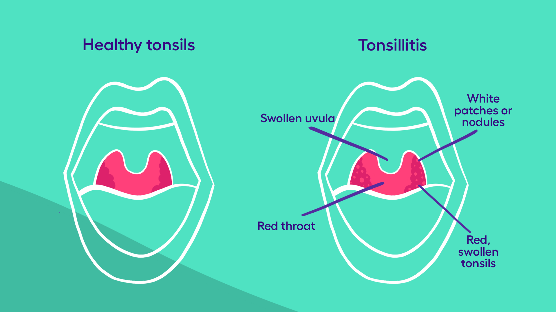 What is tonsillitis? Your guide to symptoms and treatment