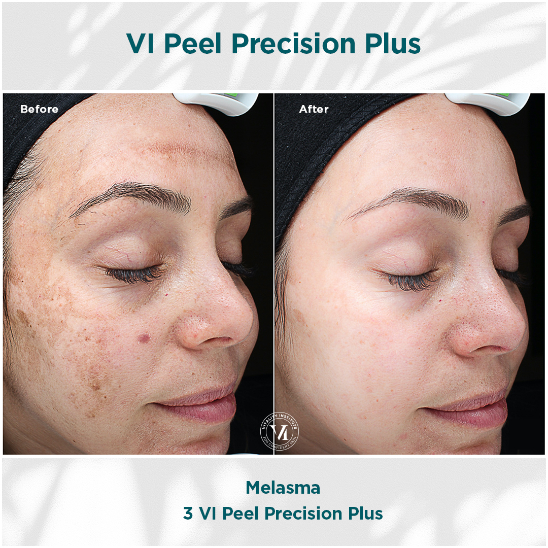 Magic in a Bottle The VI Peel Siperstein Dermatology Group