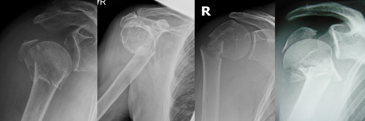 Les fractures de l’humerus proximal Le site de l'épaule