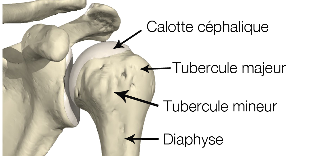Site de l'épaule, Les fractures de et autour de l’épaule peuvent
