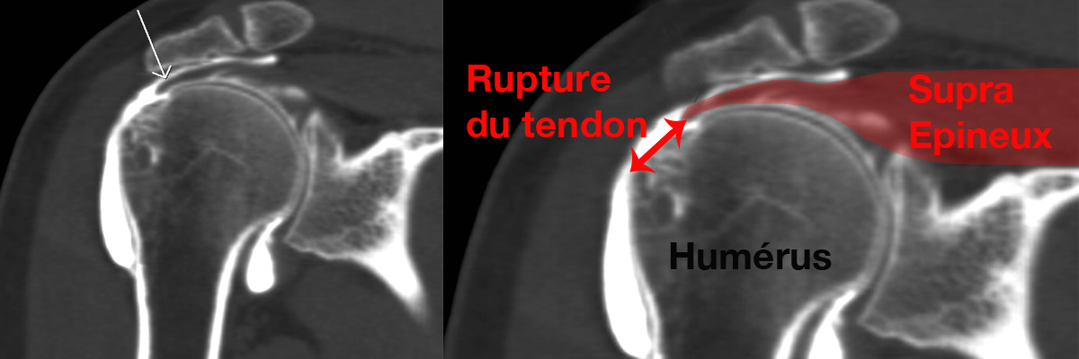 Rupture de la coiffe des rotateurs Le site de l'épaule