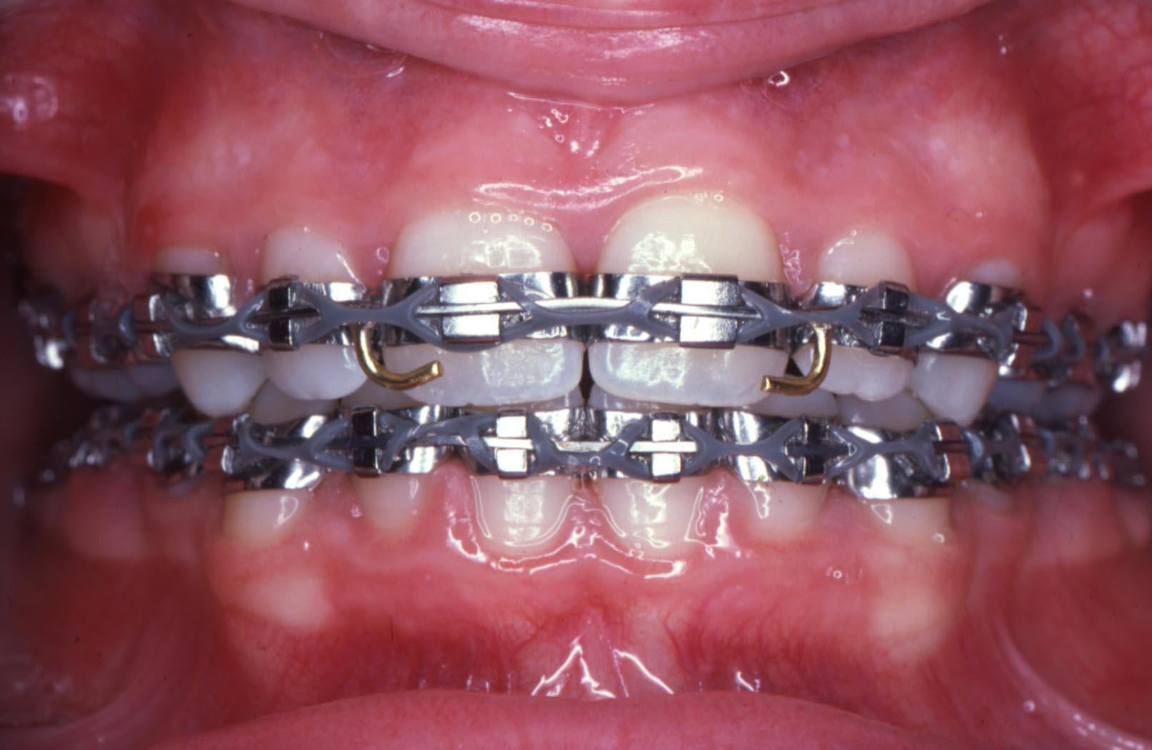 Can braces cause oral cancer? SixStep Screening