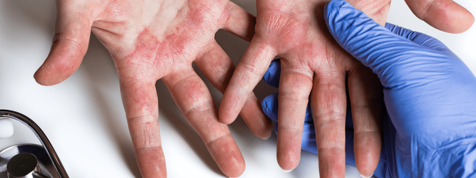 Eczema (Atopic Dermatitis) Symptoms and Treatment Options SJPP