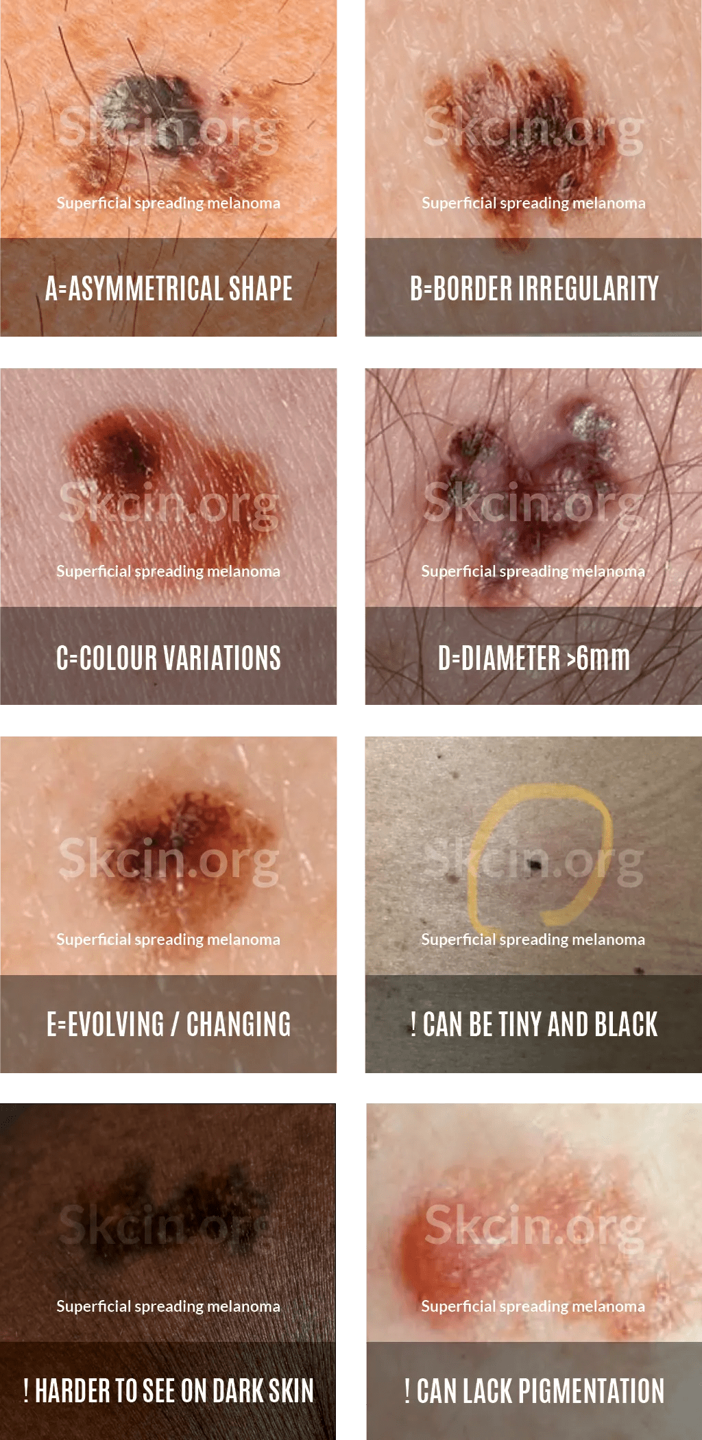 Melanoma Skin Cancer