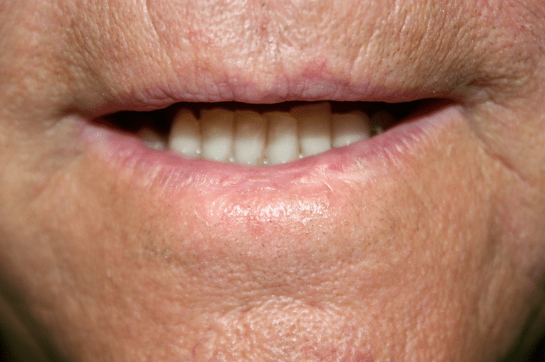 Ask the Expert What Will Help Me Feel Less Nervous About My Lip Cancer